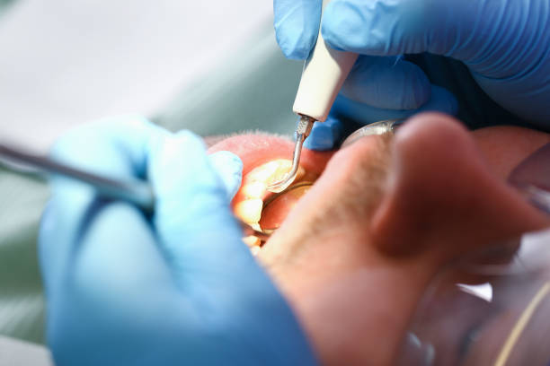 Best Emergency Wisdom Teeth Removal in Mendon, UT